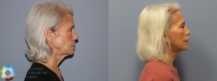 Before & After Mini Facelift Case 12112 Right Side in Denver and Colorado Springs, CO