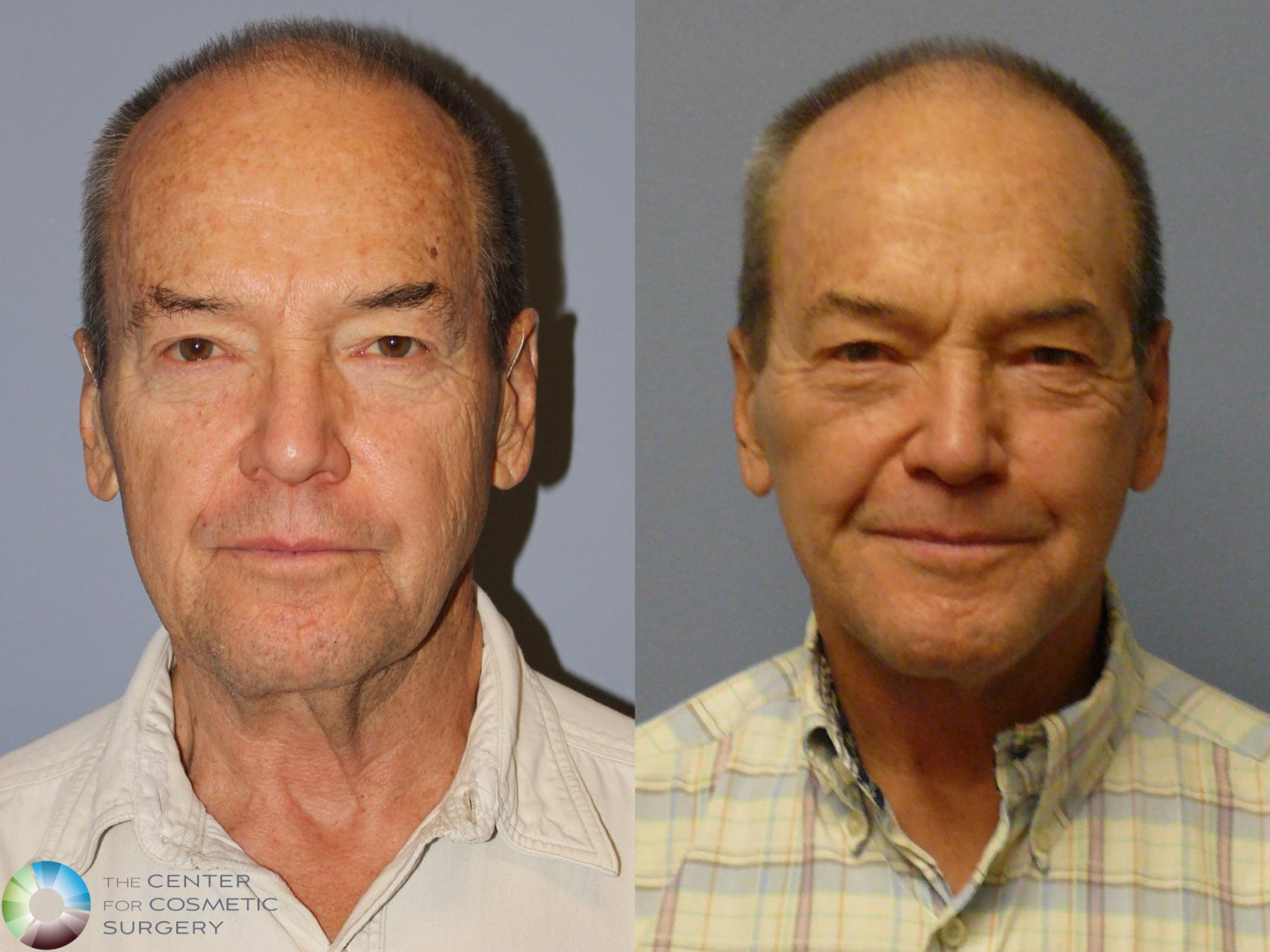 Before & After Mini Facelift Case 12113 Front in Denver and Colorado Springs, CO