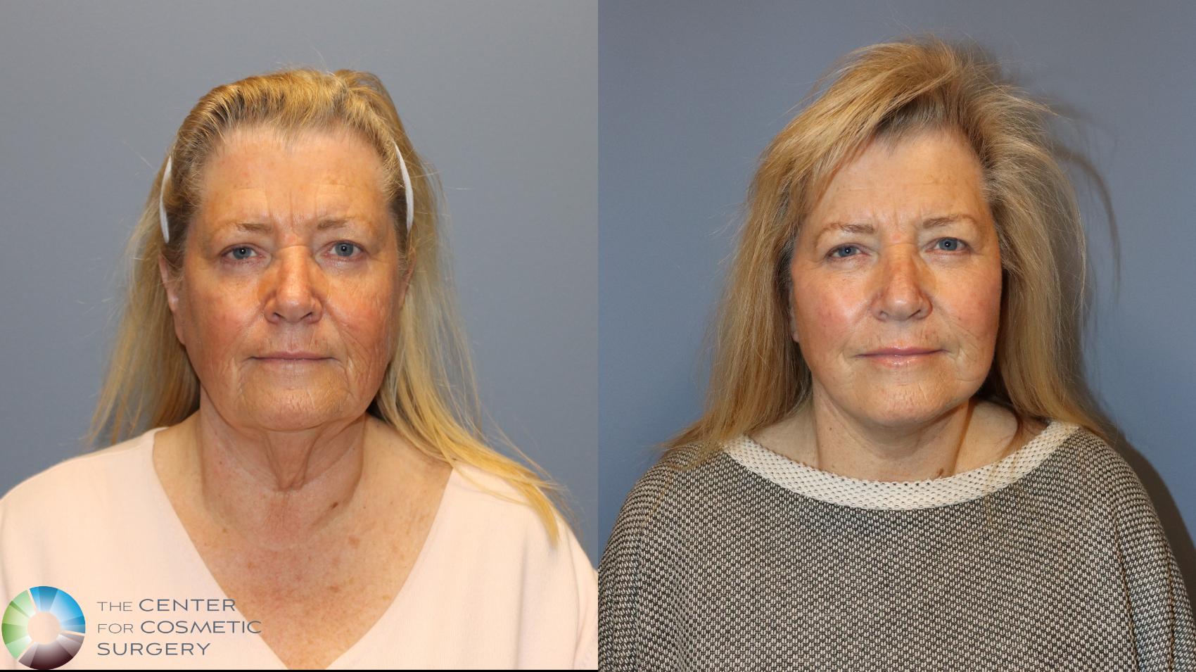 Before & After Mini Facelift Case 12131 Front in Denver and Colorado Springs, CO