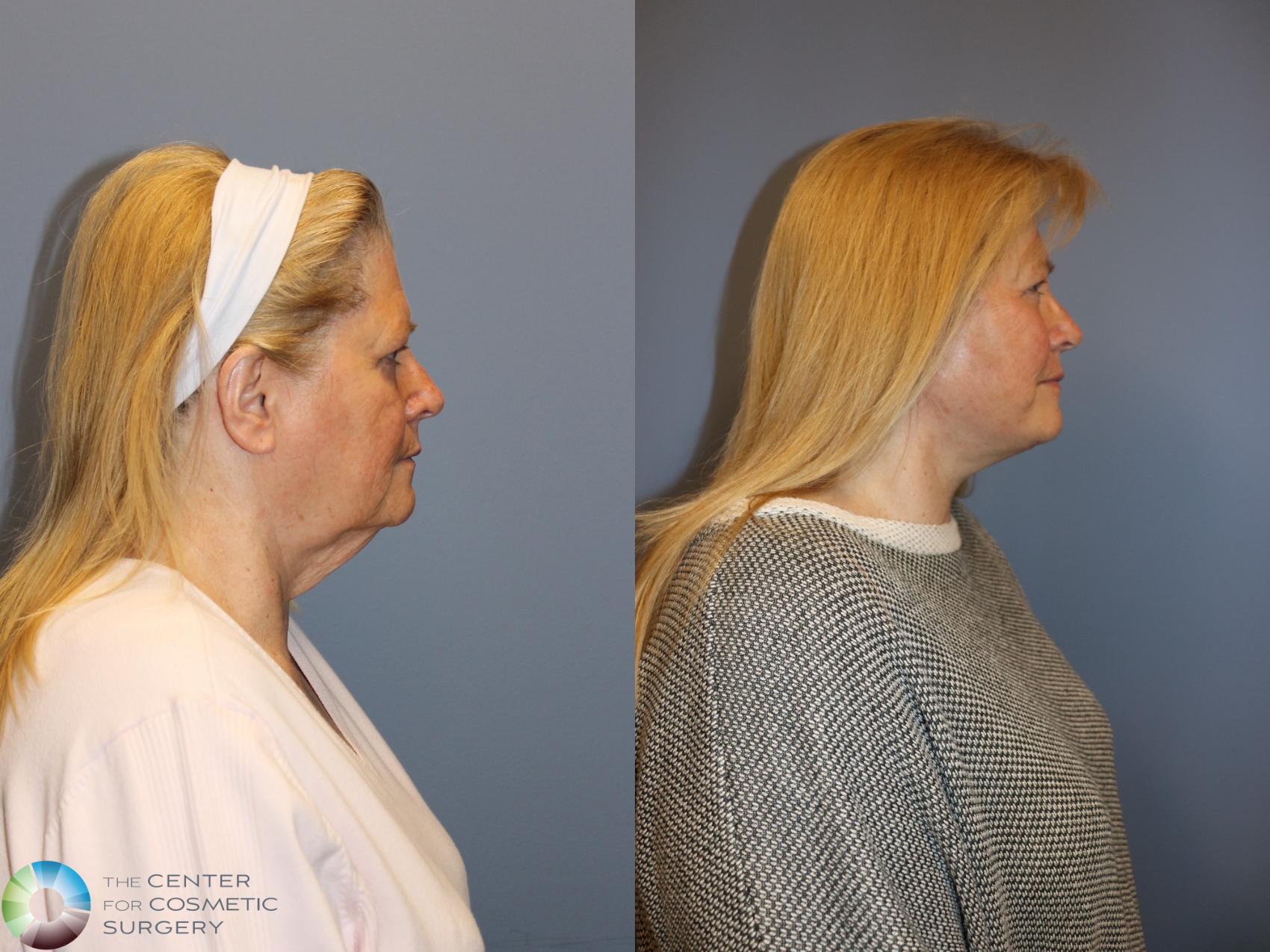 Before & After Mini Facelift Case 12131 Right Side in Denver and Colorado Springs, CO