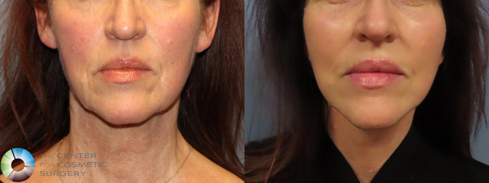 Before & After Mini Facelift Case 12132 Front in Denver and Colorado Springs, CO