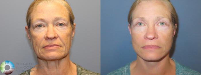 Best Denver Mini-Facelift/Neck Lift