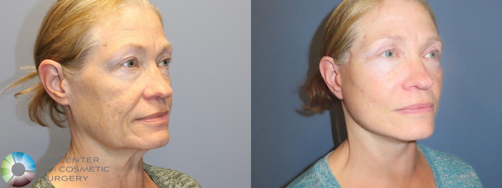 Before & After Mini Facelift Case 12153 Right Oblique in Denver and Colorado Springs, CO