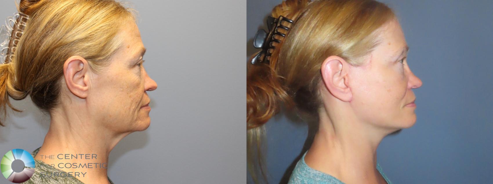 Before & After Mini Facelift Case 12153 Right Side in Denver and Colorado Springs, CO