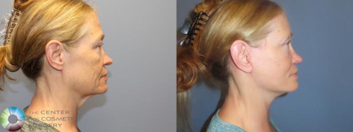 Best Denver Mini-Facelift/Neck Lift