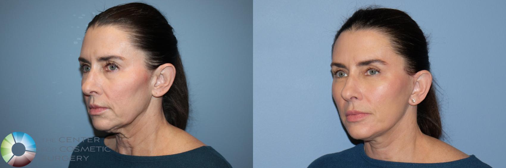 Before & After Mini Facelift Case 12168 Left Oblique in Denver and Colorado Springs, CO