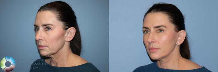 Before & After Eyelid Lift Case 12168 Left Oblique in Denver and Colorado Springs, CO