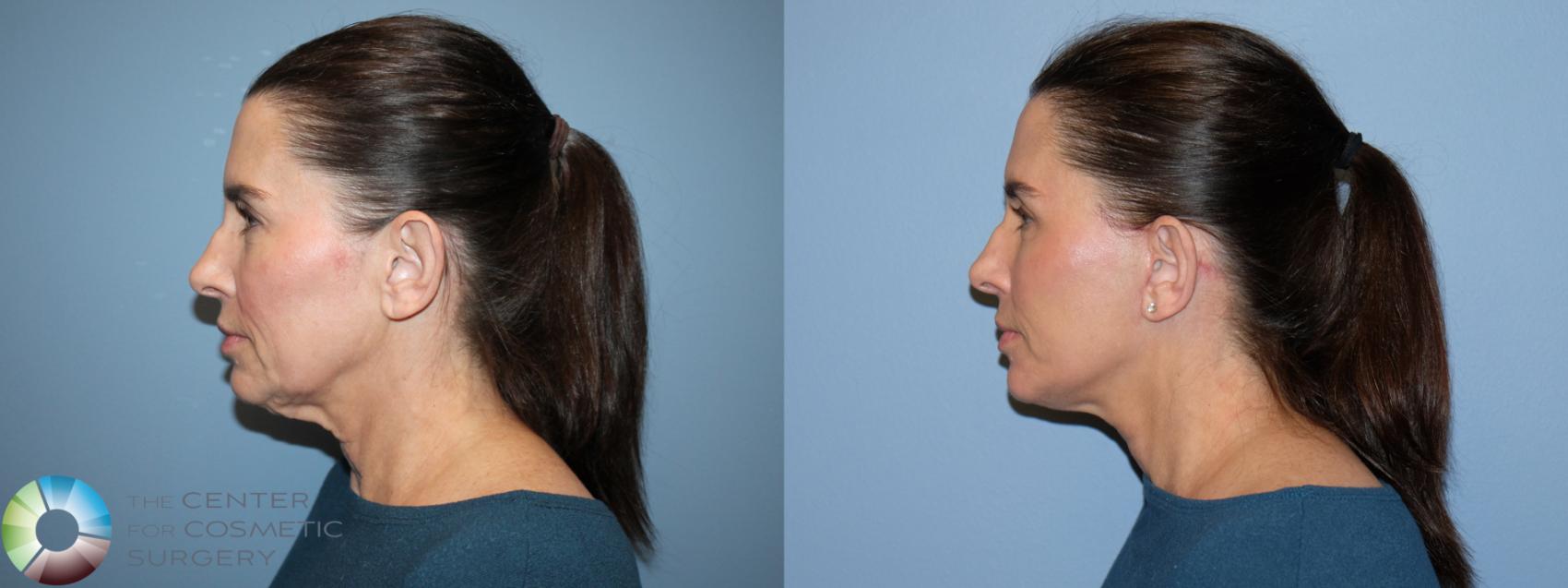 Before & After Mini Facelift Case 12168 Left Side in Denver and Colorado Springs, CO