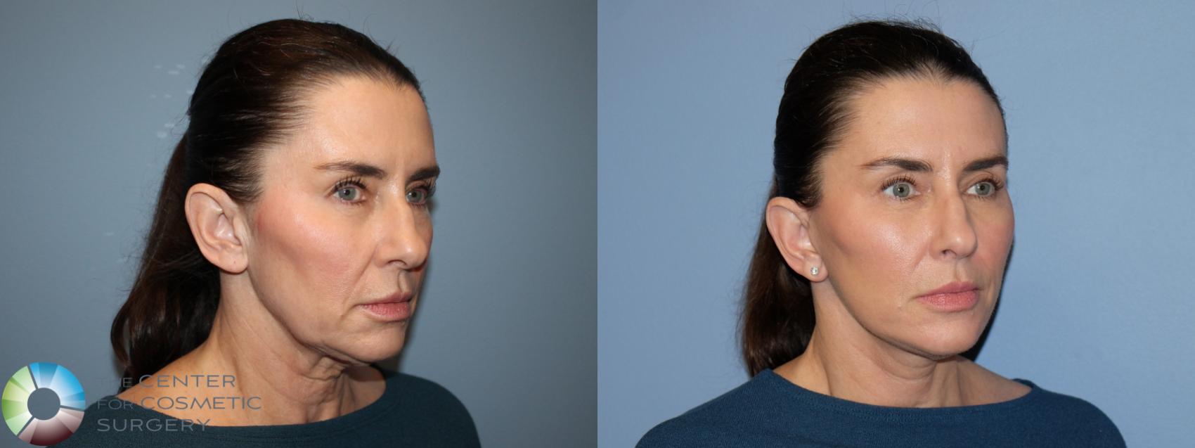 Before & After Mini Facelift Case 12168 Right Oblique in Denver and Colorado Springs, CO