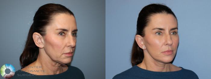 Before & After Eyelid Lift Case 12168 Right Oblique in Denver and Colorado Springs, CO