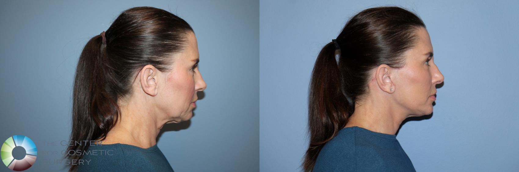Before & After Mini Facelift Case 12168 Right Side in Denver and Colorado Springs, CO