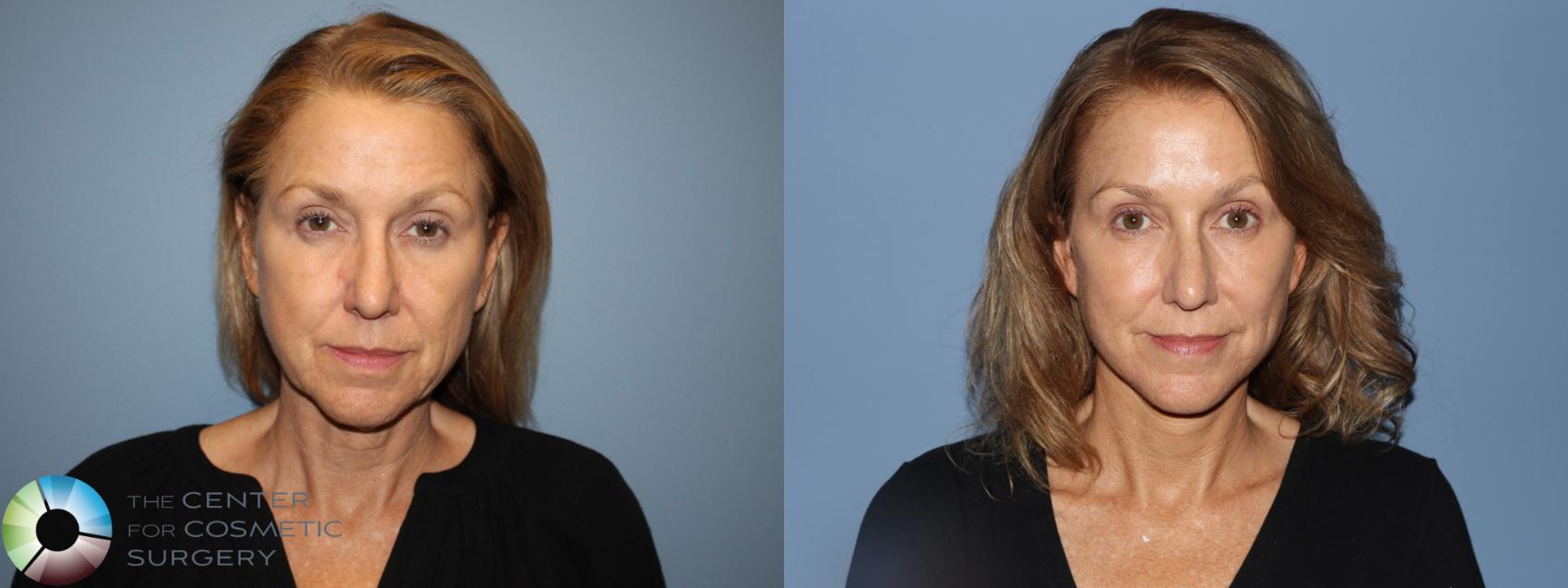 Before & After Mini Facelift Case 12181 Front in Denver and Colorado Springs, CO