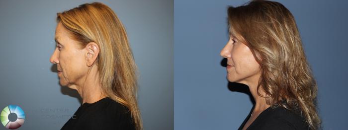 Before & After Mini Facelift Case 12181 Left Side in Denver and Colorado Springs, CO