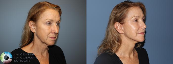 Before & After Mini Facelift Case 12181 Right Oblique in Denver and Colorado Springs, CO