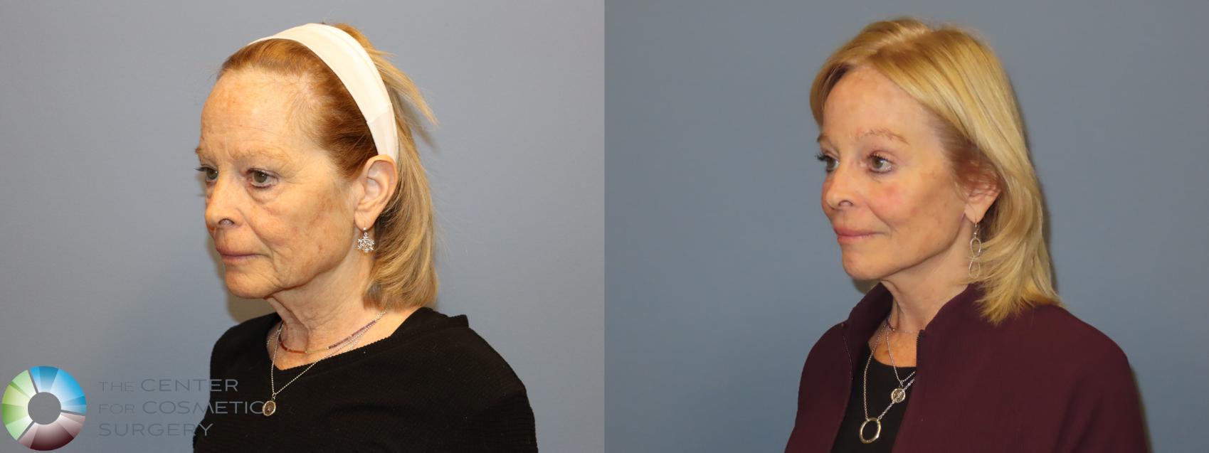Before & After Mini Facelift Case 12183 Left Oblique in Denver and Colorado Springs, CO
