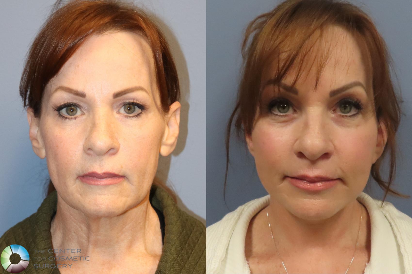 Best Denver Mini-Facelift/Neck Lift
