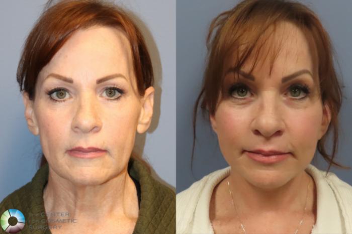 Best Denver Mini-Facelift/Neck Lift