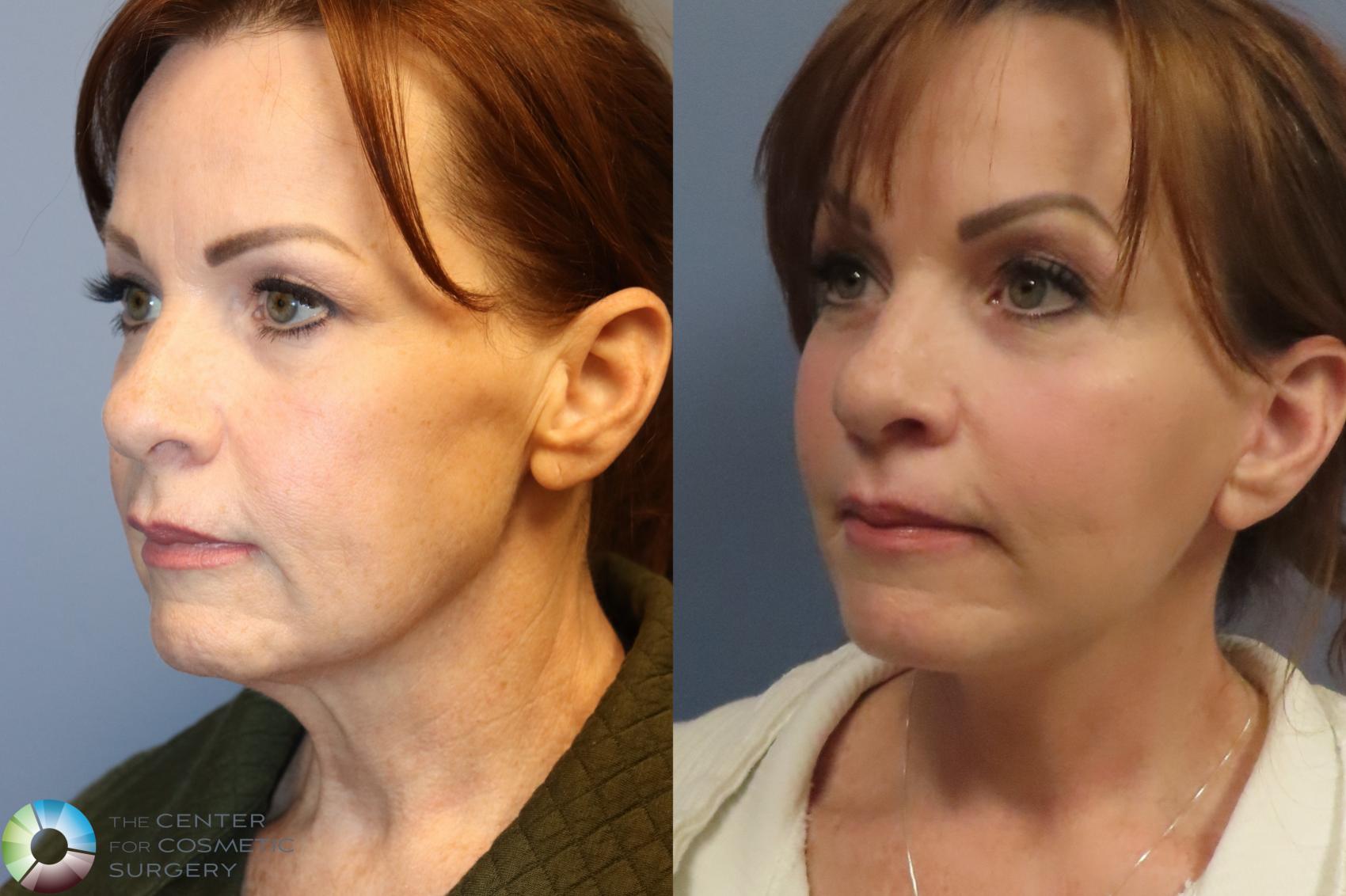 Before & After Mini Facelift Case 12216 Left Oblique in Denver and Colorado Springs, CO