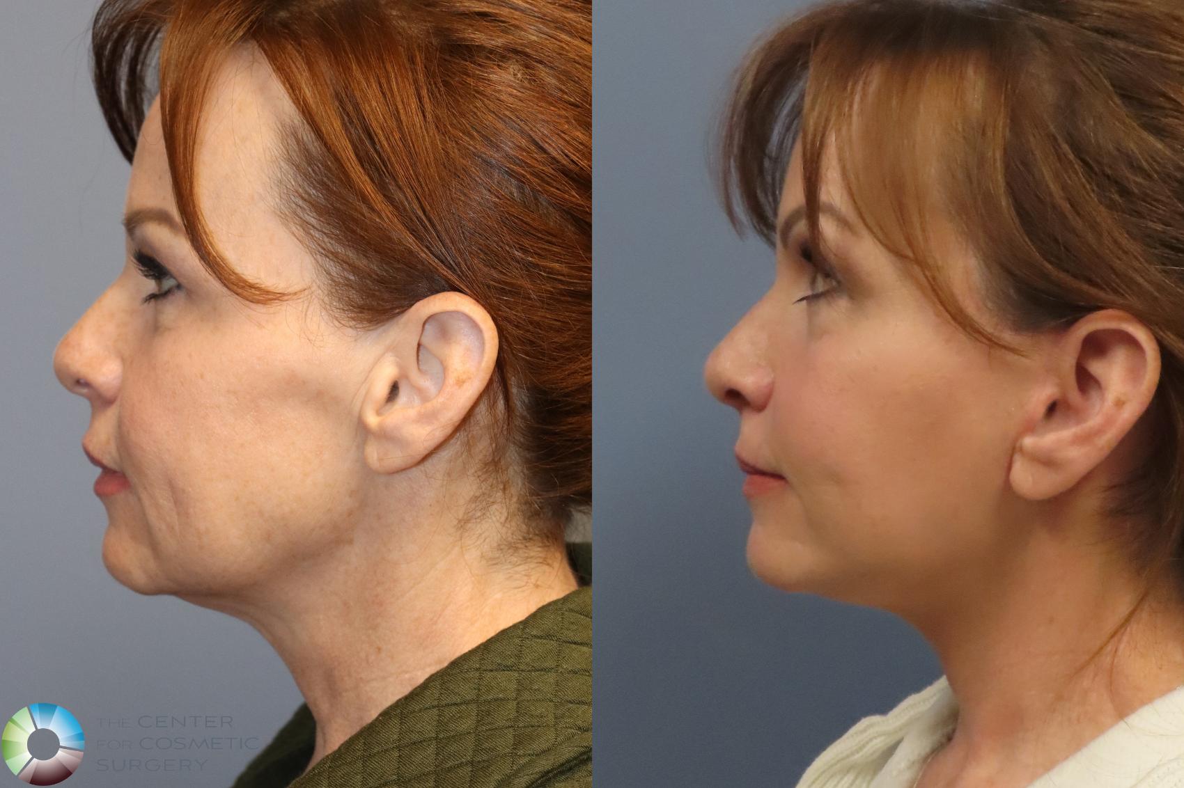 Before & After Mini Facelift Case 12216 Left Side in Denver and Colorado Springs, CO
