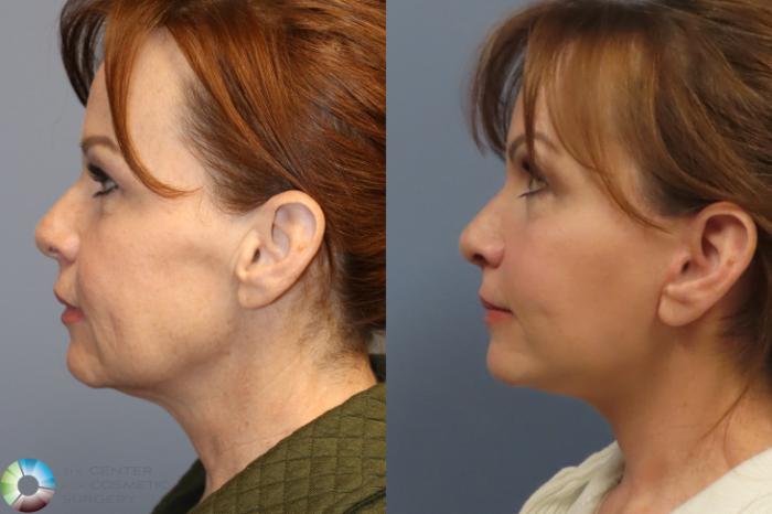 Best Denver Mini-Facelift/Neck Lift