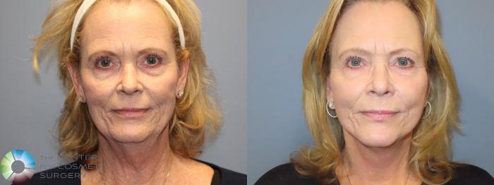 Best Denver Mini-Facelift/Neck Lift