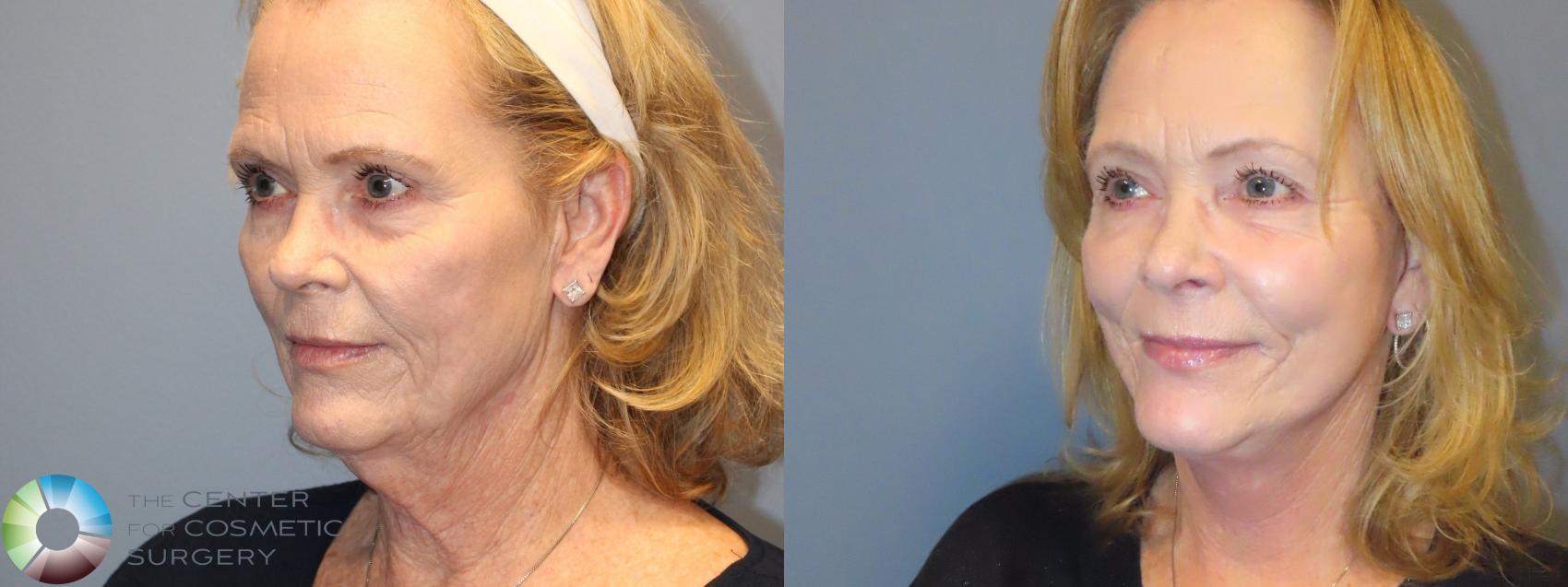Before & After Mini Facelift Case 12217 Left Oblique in Denver and Colorado Springs, CO