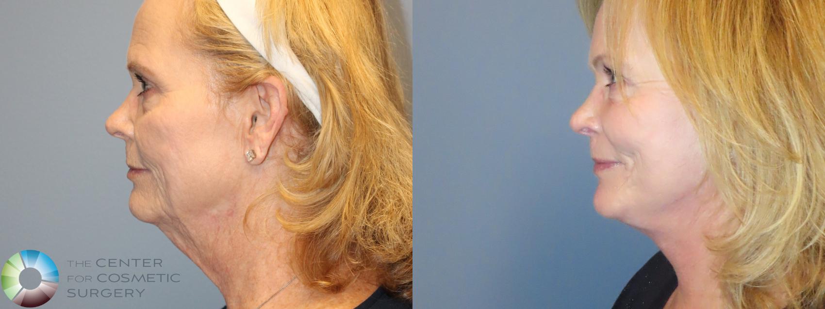 Before & After Mini Facelift Case 12217 Left Side in Denver and Colorado Springs, CO