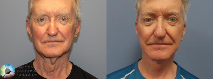 Best Denver Mini-Facelift/Neck Lift