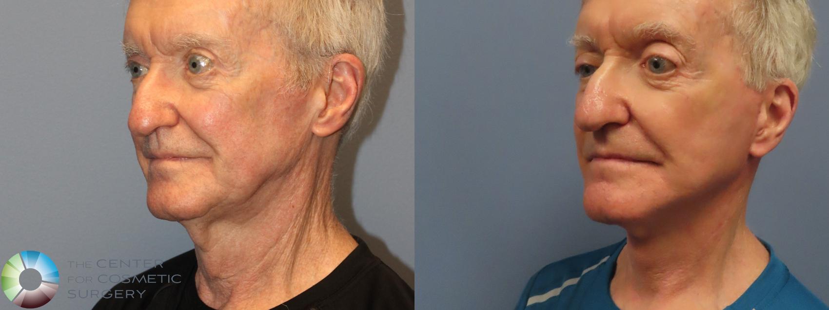 Before & After Mini Facelift Case 12218 Left Oblique in Denver and Colorado Springs, CO