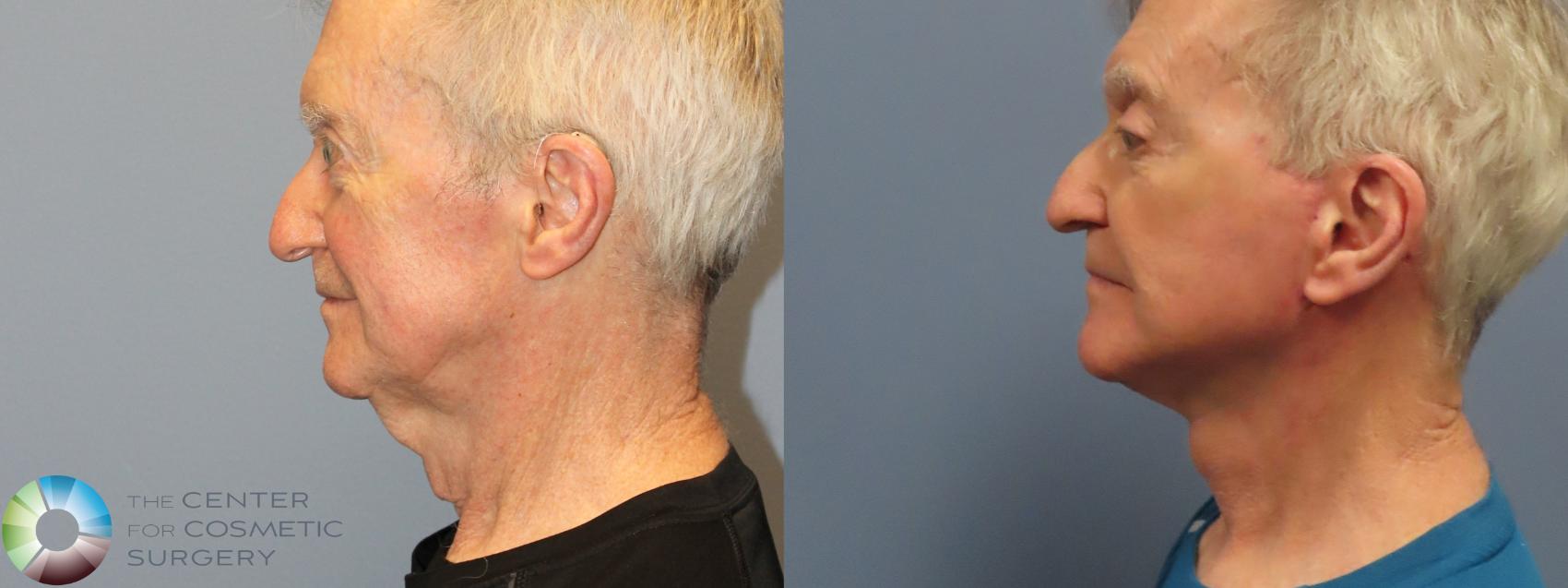 Before & After Mini Facelift Case 12218 Left Side in Denver and Colorado Springs, CO
