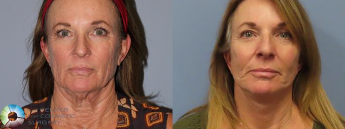 Best Denver Mini-Facelift/Neck Lift