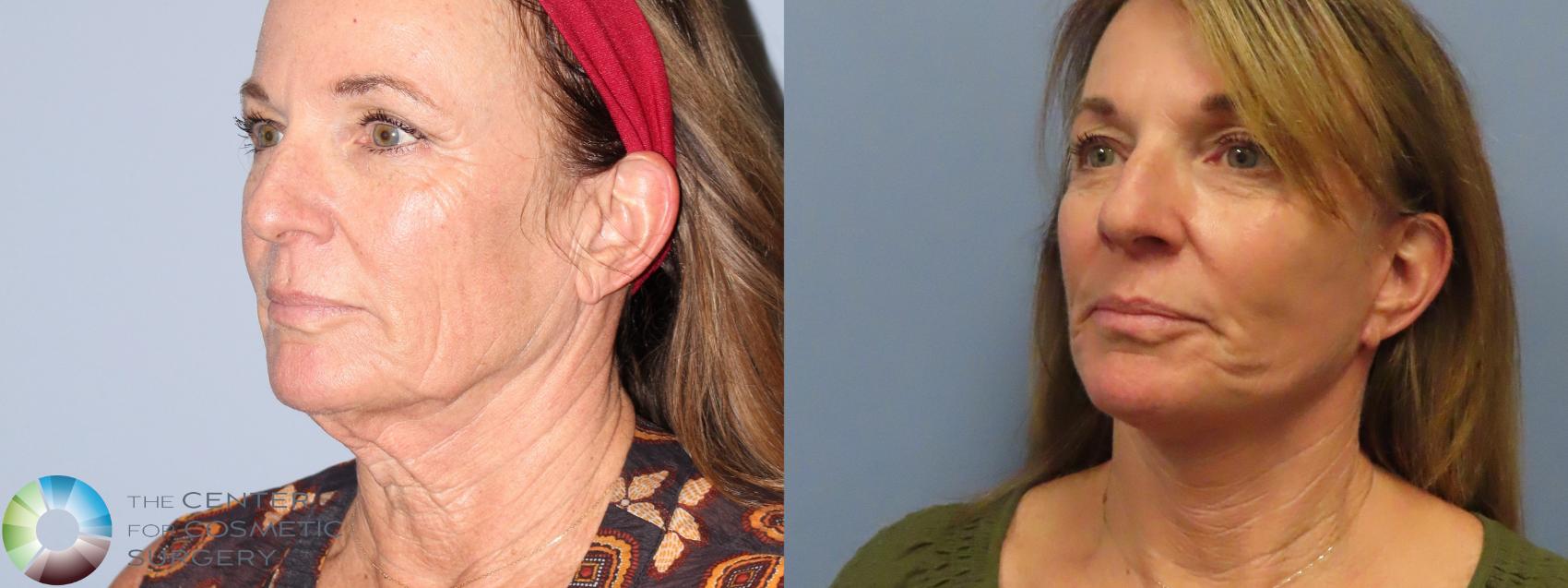 Before & After Mini Facelift Case 12219 Left Oblique in Denver and Colorado Springs, CO