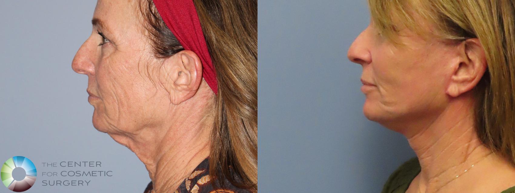 Before & After Mini Facelift Case 12219 Left Side in Denver and Colorado Springs, CO
