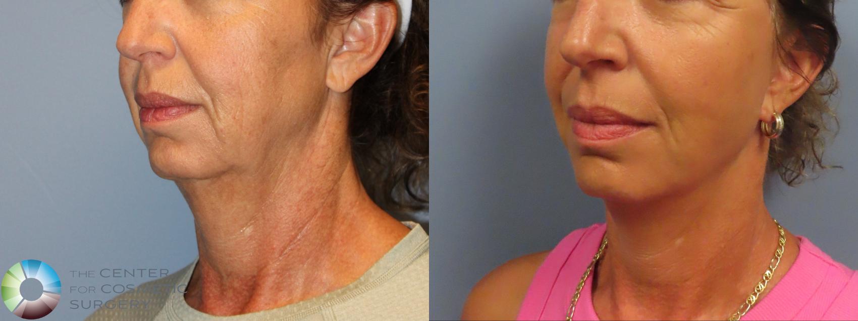 Before & After Mini Facelift Case 12220 Left Oblique in Denver and Colorado Springs, CO