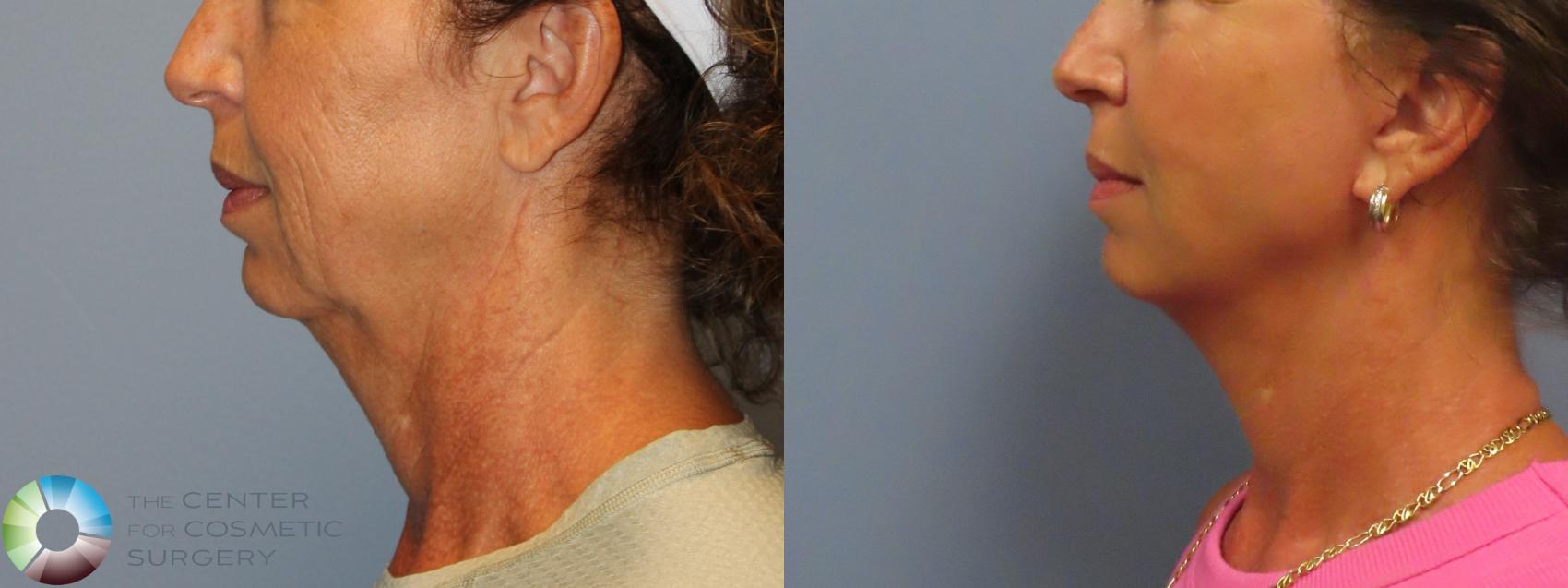 Before & After Mini Facelift Case 12220 Left Side in Denver and Colorado Springs, CO