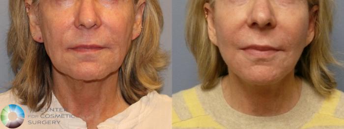 Best Denver Mini-Facelift/Neck Lift
