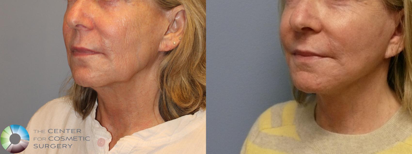 Before & After Mini Facelift Case 12221 Left Oblique in Denver and Colorado Springs, CO