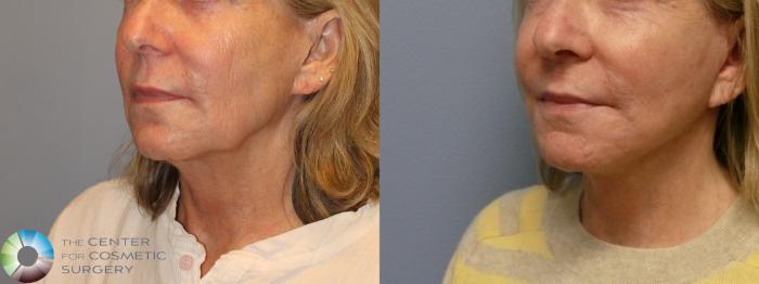Best Denver Mini-Facelift/Neck Lift