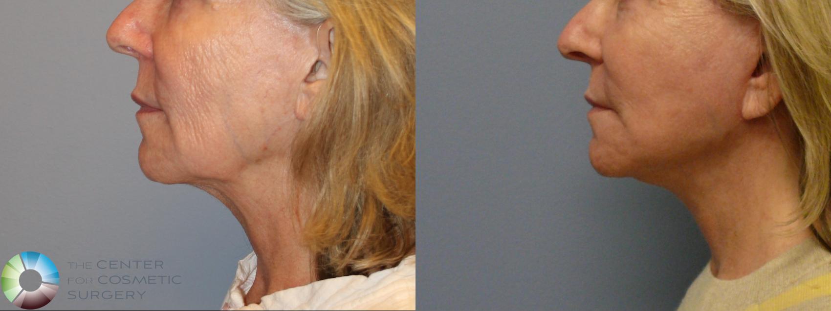 Before & After Mini Facelift Case 12221 Left Side in Denver and Colorado Springs, CO