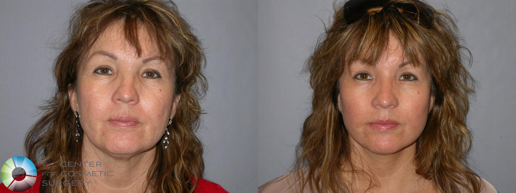Before & After Mini Facelift Case 127 View #1 View in Golden, CO