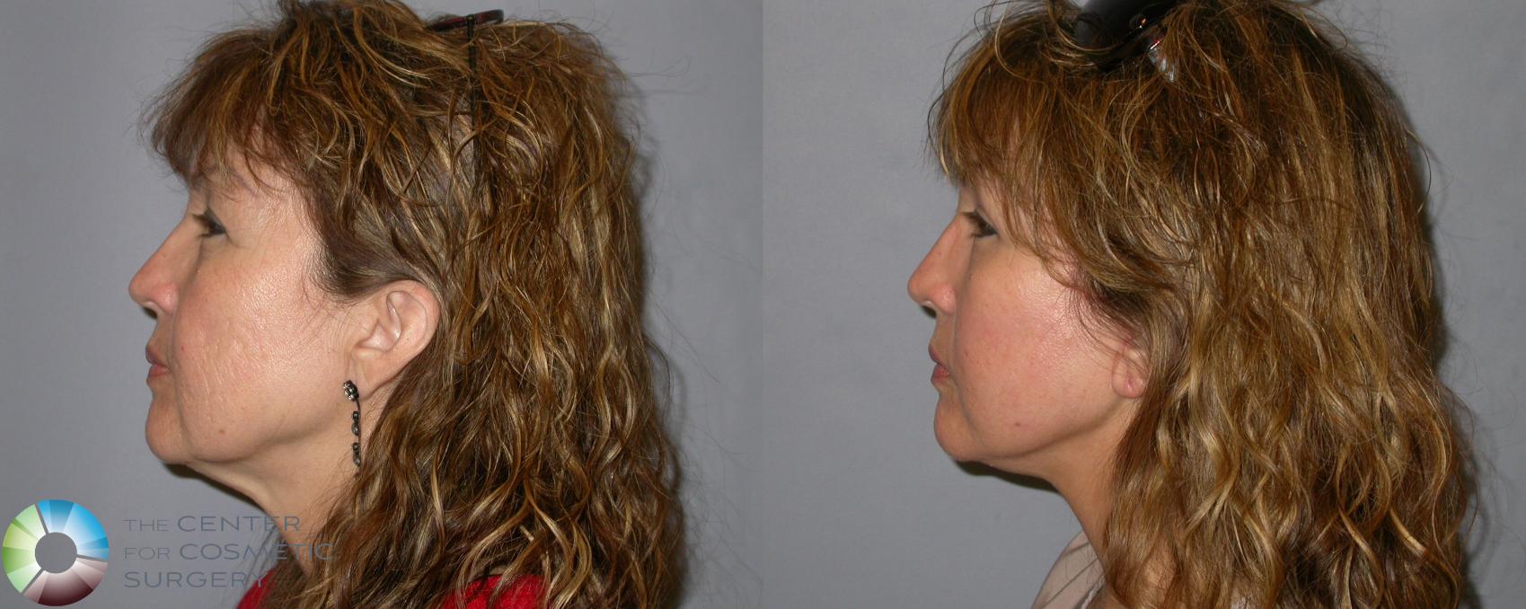 Before & After Mini Facelift Case 127 View #3 View in Golden, CO