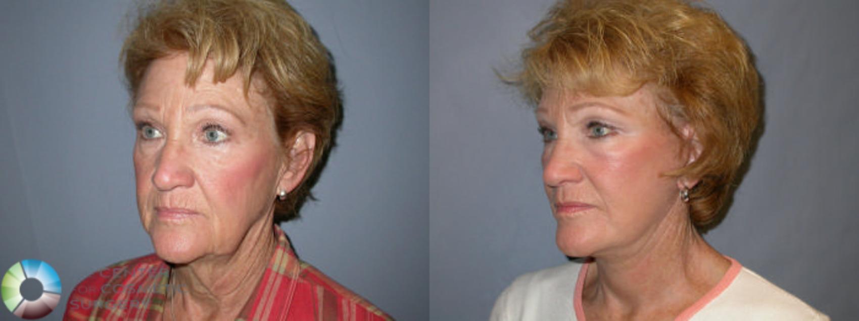 Before & After Eyelid Lift Case 13 View #1 in Denver, CO