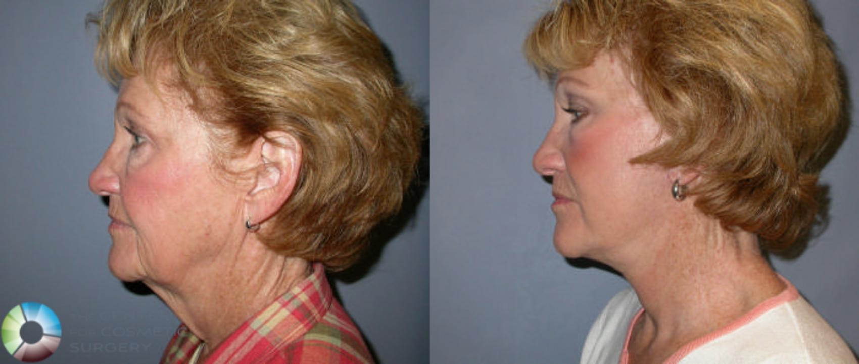 Before & After Eyelid Lift Case 13 View #2 View in Golden, CO