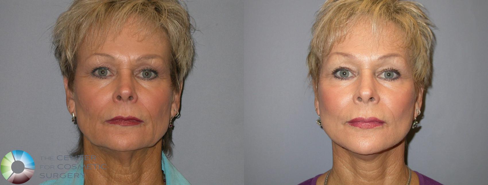 Before & After Mini Facelift Case 135 View #1 View in Golden, CO