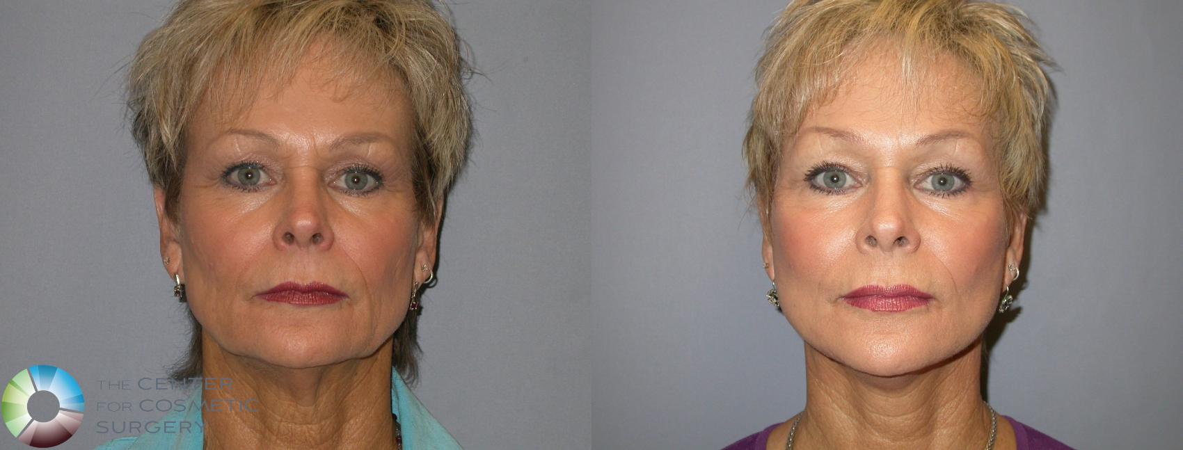 Before & After Facelift Case 135 View #1 in Denver and Colorado Springs, CO