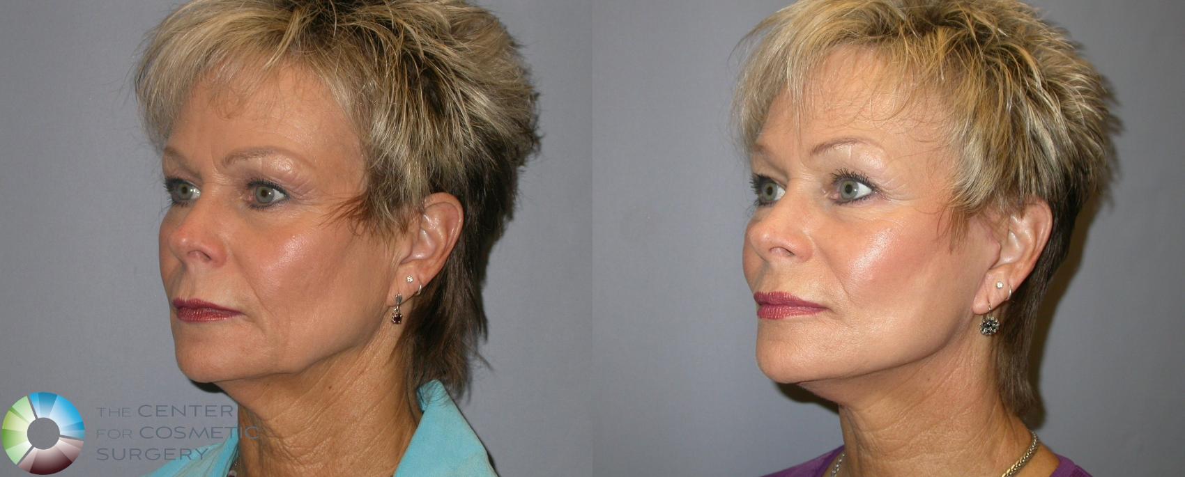 Before & After Mini Facelift Case 135 View #2 View in Golden, CO