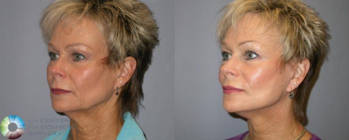 Before & After Mini Facelift Case 135 View #2 in Denver and Colorado Springs, CO