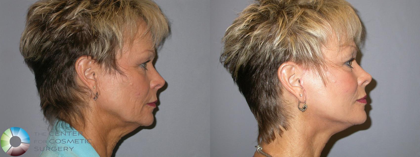 Before & After Mini Facelift Case 135 View #3 View in Golden, CO