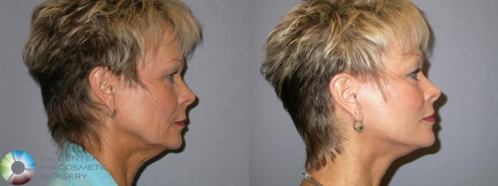 Before & After Mini Facelift Case 135 View #3 in Denver and Colorado Springs, CO