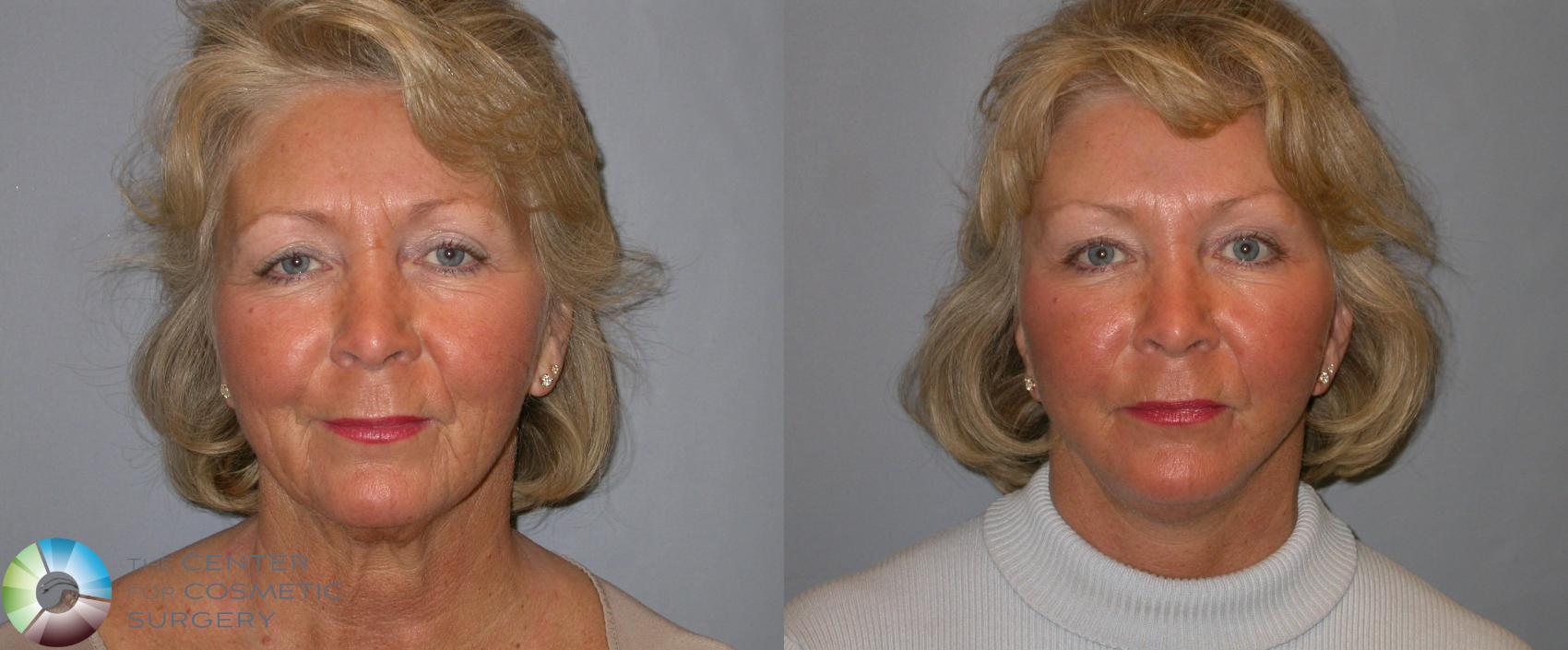 Before & After Facelift Case 136 View #1 in Denver and Colorado Springs, CO